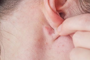 Image illustrative de l'article Boule derrière l'oreille : 6 causes principales (et que faire)