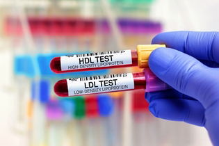 Imagen ilustrativa del artículo Colesterol HDL bajo: síntomas, causas y si es peligroso