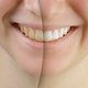 Imagen ilustrativa del artículo ¿Cómo blanquear los dientes?: 8 tratamientos efectivos